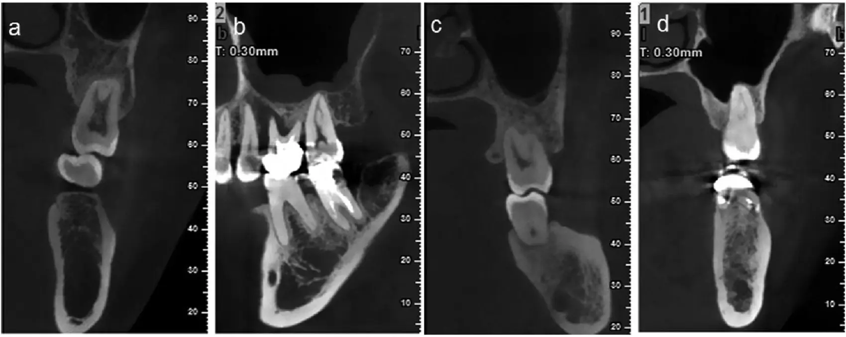Access Endodontics - Dr. Lee - Advanced Technology 3D Imanging-2