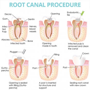 root-canal-coppell-texas