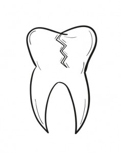 cracked tooth root canal Coppell
