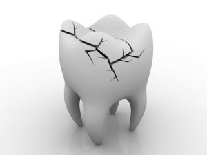root canal treatment Coppell